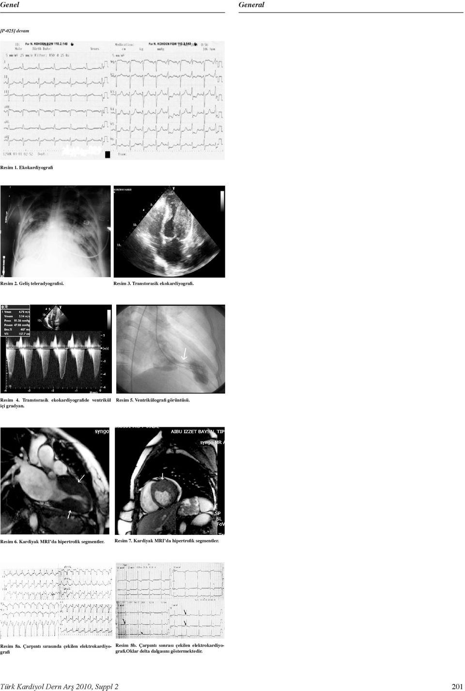 Kardiyak MRI da hipertrofik segmentler. Resim 7. Kardiyak MRI da hipertrofik segmentler. Resim 8a.