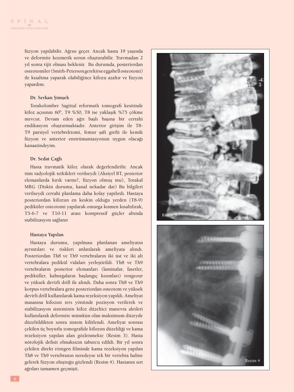 Serkan Şimşek Torakolomber Sagittal reformatlı tomografi kesitinde kifoz açısının 60 0, T9 %50, T8 ise yaklaşık %75 çökme mevcut. Devam eden ağrı başlı başına bir cerrahi endikasyon oluşturmaktadır.