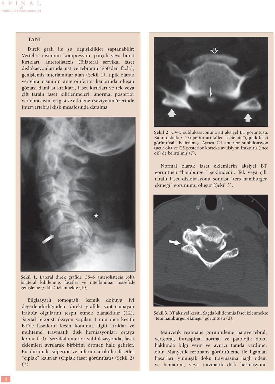 kilitlenmeleri, anormal posterior vertebra cisim çizgisi ve etkilenen seviyenin üzerinde intervertebral disk mesafesinde daralma. Şekil 2. C4 5 subluksasyonuna ait aksiyel BT görüntüsü.