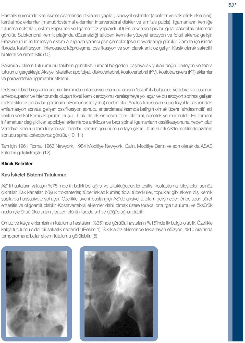 Subkondral kemik plağında düzensizliği takiben kemikte yüzeyel erozyon ve fokal skleroz gelişir. Erozyonunun ilerlemesiyle eklem aralığında yalancı genişlemeler (pseudowidening) görülür.