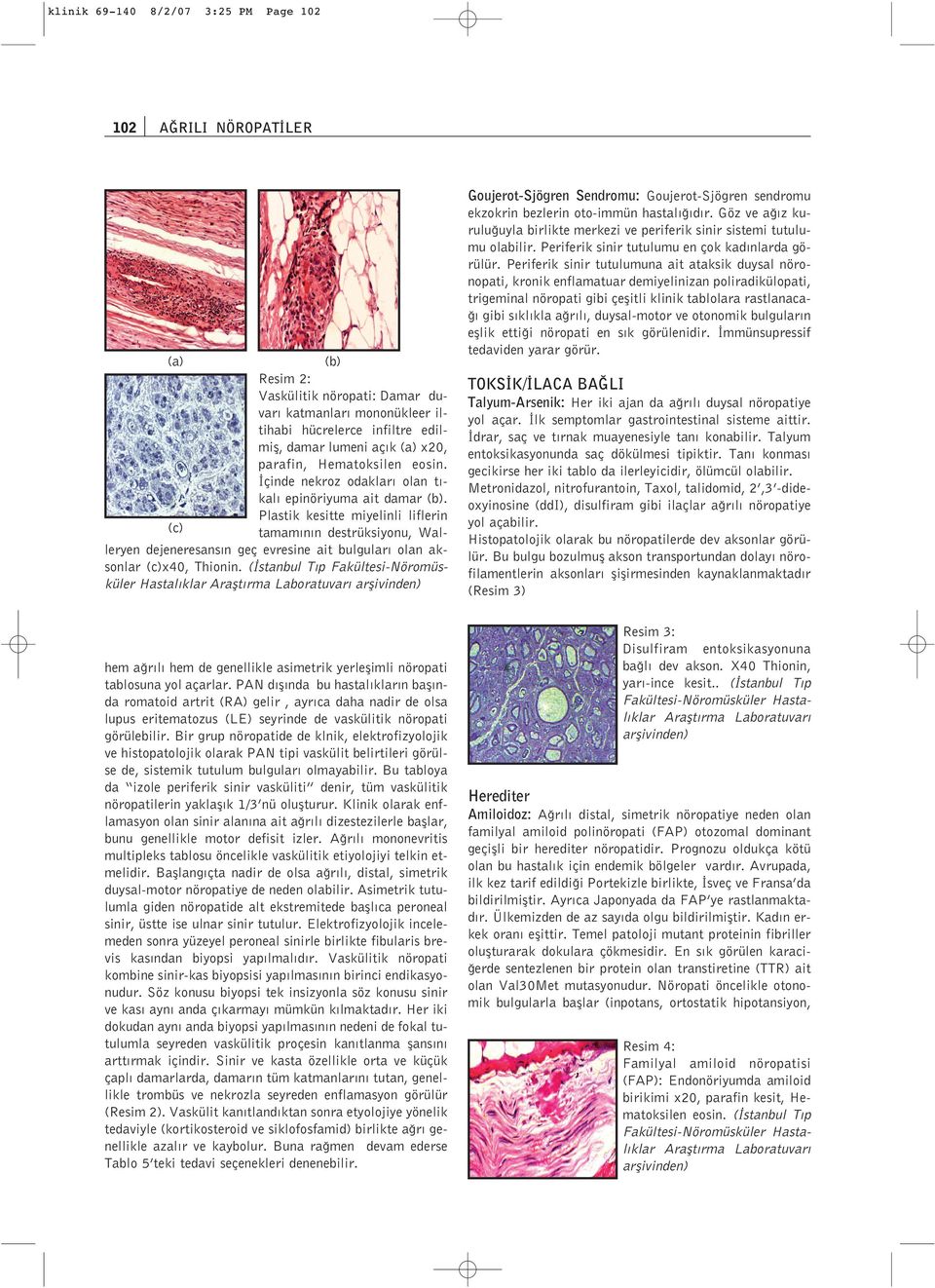 Plastik kesitte miyelinli liflerin (c) tamam n n destrüksiyonu, Walleryen dejeneresans n geç evresine ait bulgular olan aksonlar (c)x40, Thionin.