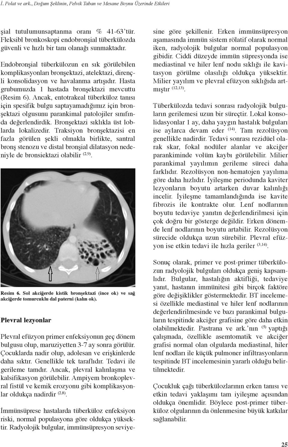 Endobronşial tüberkülozun en sık görülebilen komplikasyonları bronşektazi, atelektazi, dirençli konsolidasyon ve havalanma artışıdır. Hasta grubumuzda 1 hastada bronşektazi mevcuttu (Resim 6).