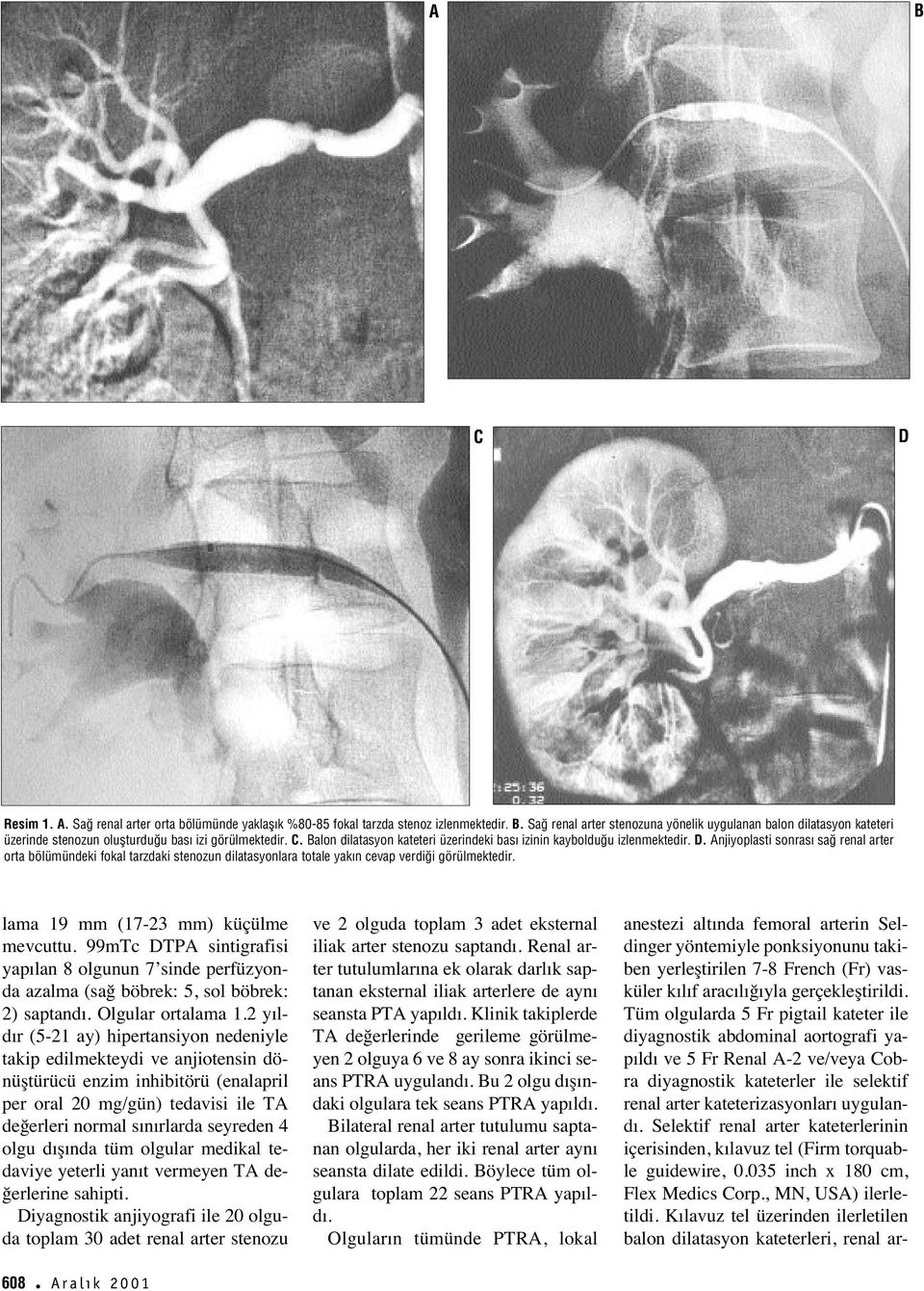 Anjiyoplasti sonras sa renal arter orta bölümündeki fokal tarzdaki stenozun dilatasyonlara totale yak n cevap verdi i görülmektedir. lama 19 mm (17-23 mm) küçülme mevcuttu.