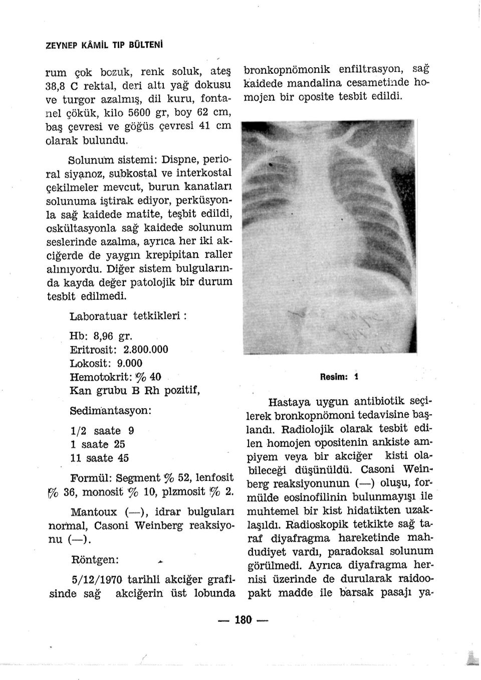 Solunum sistemi: Dispne, perioral siy~noz, subko stal ve interkostal çekilmeler mevcut, burun kanatları s olunuma iştirak ediyor, perküsyonla sağ kaidede matite, teşbit edildi, oskültasyonla sağ