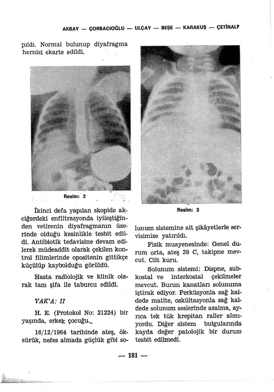 Antibiotik tedavisine devam edilerek müdeaddit olaiak çekilen kontrol filimlerinde opositenin gittikçe 1 küçülüp kaybolduğu görüldü. Hasta radiolojik ve klinik ola rak tam şifa ile taburcu edildi.