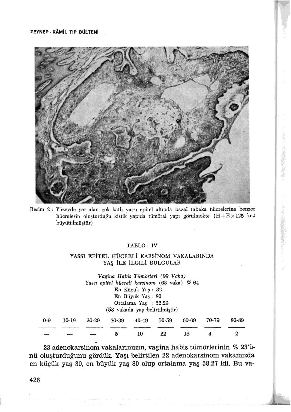 . t u r) TABL-0: IV YASSI EPİTEL HÜCRELİ KARSİNOM VAKALARINDA YAŞ İLE İLGiLİ BULGULAR Vagina Habis Tümörleri ( 99 V aka) Yassı epitel hücreli karsinom ( 63 vaka) % 64 En Küçük Yaş :