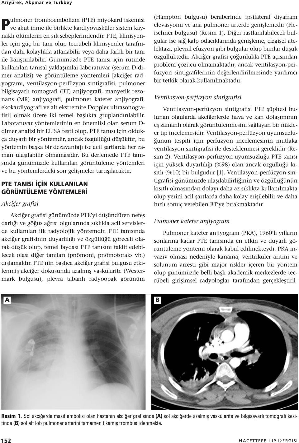 Günümüzde PTE tanısı için rutinde kullanılan tanısal yaklaşımlar laboratuvar (serum D-dimer analizi) ve görüntüleme yöntemleri [akciğer radyogramı, ventilasyon-perfüzyon sintigrafisi, pulmoner