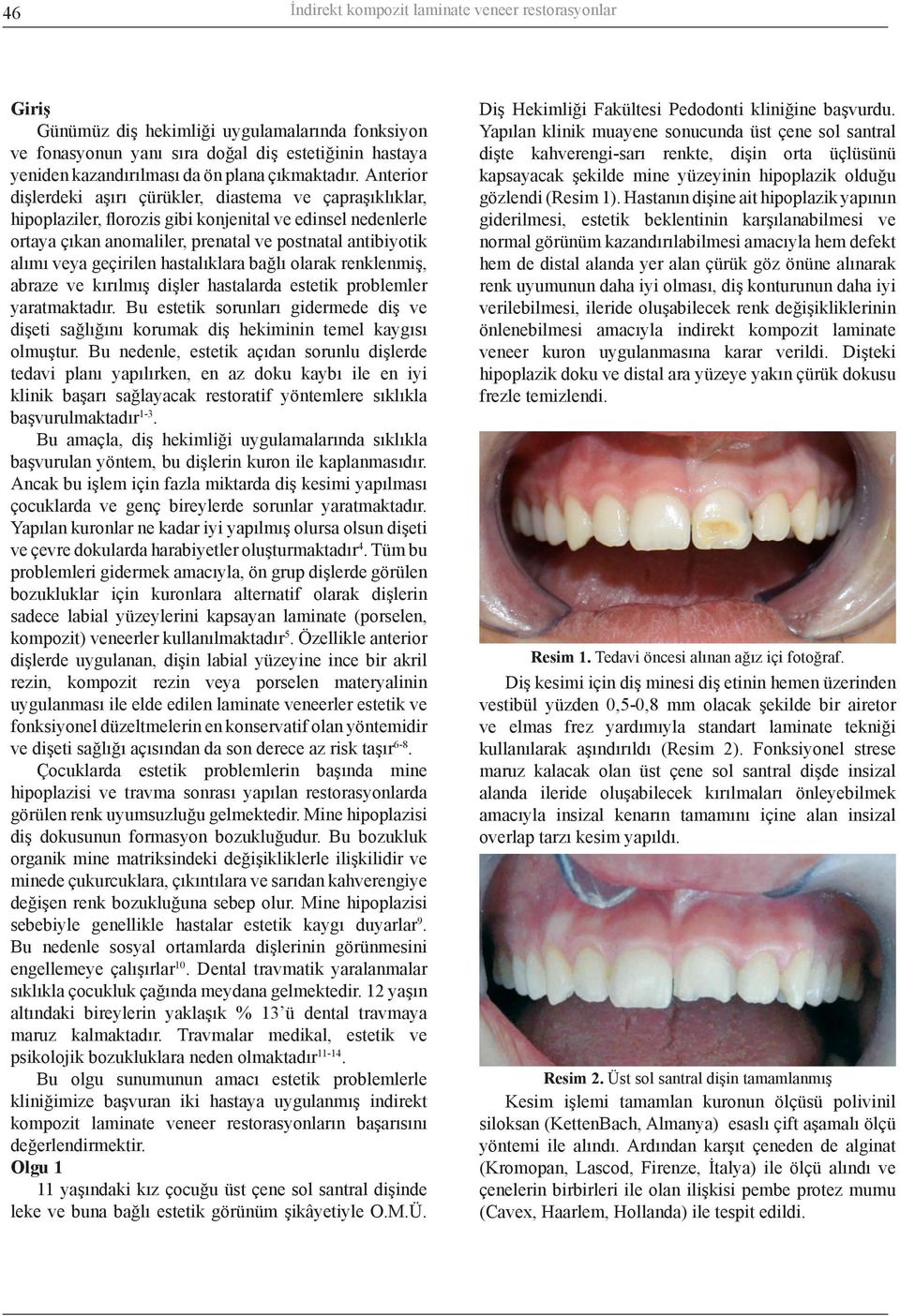 Anterior dişlerdeki aşırı çürükler, diastema ve çapraşıklıklar, hipoplaziler, florozis gibi konjenital ve edinsel nedenlerle ortaya çıkan anomaliler, prenatal ve postnatal antibiyotik alımı veya