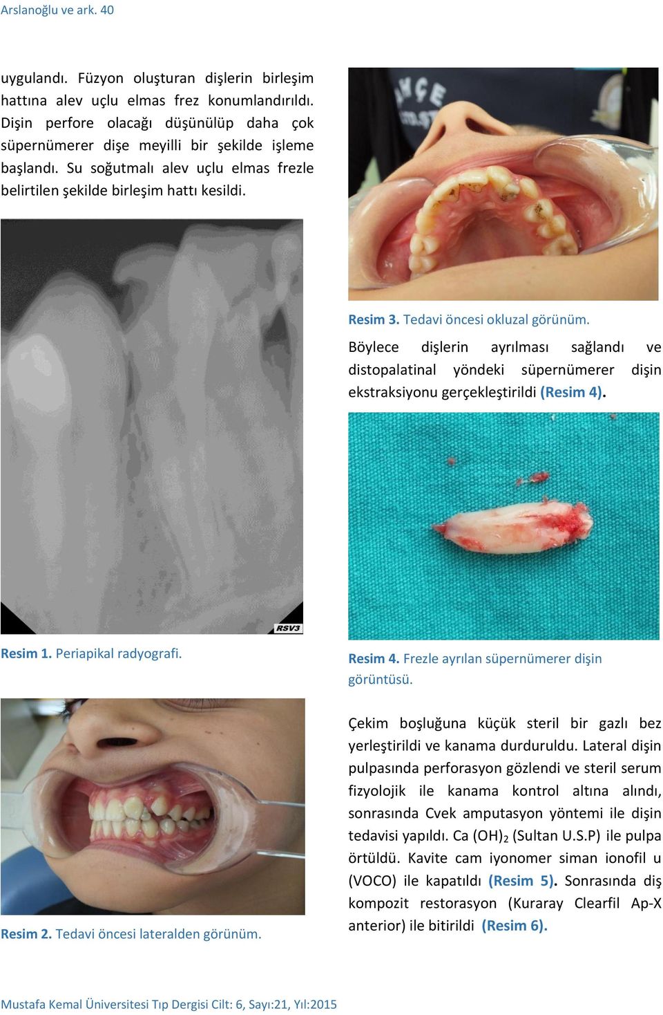 Tedavi öncesi okluzal görünüm. Böylece dişlerin ayrılması sağlandı ve distopalatinal yöndeki süpernümerer dişin ekstraksiyonu gerçekleştirildi (Resim 4). Resim 1. Periapikal radyografi. Resim 4.