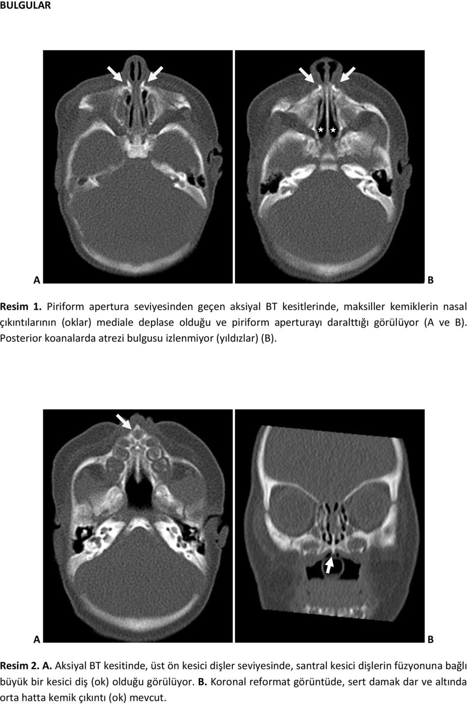 olduğu ve piriform aperturayı daralttığı görülüyor ( ve ). Posterior koanalarda atrezi bulgusu izlenmiyor (yıldızlar) ().