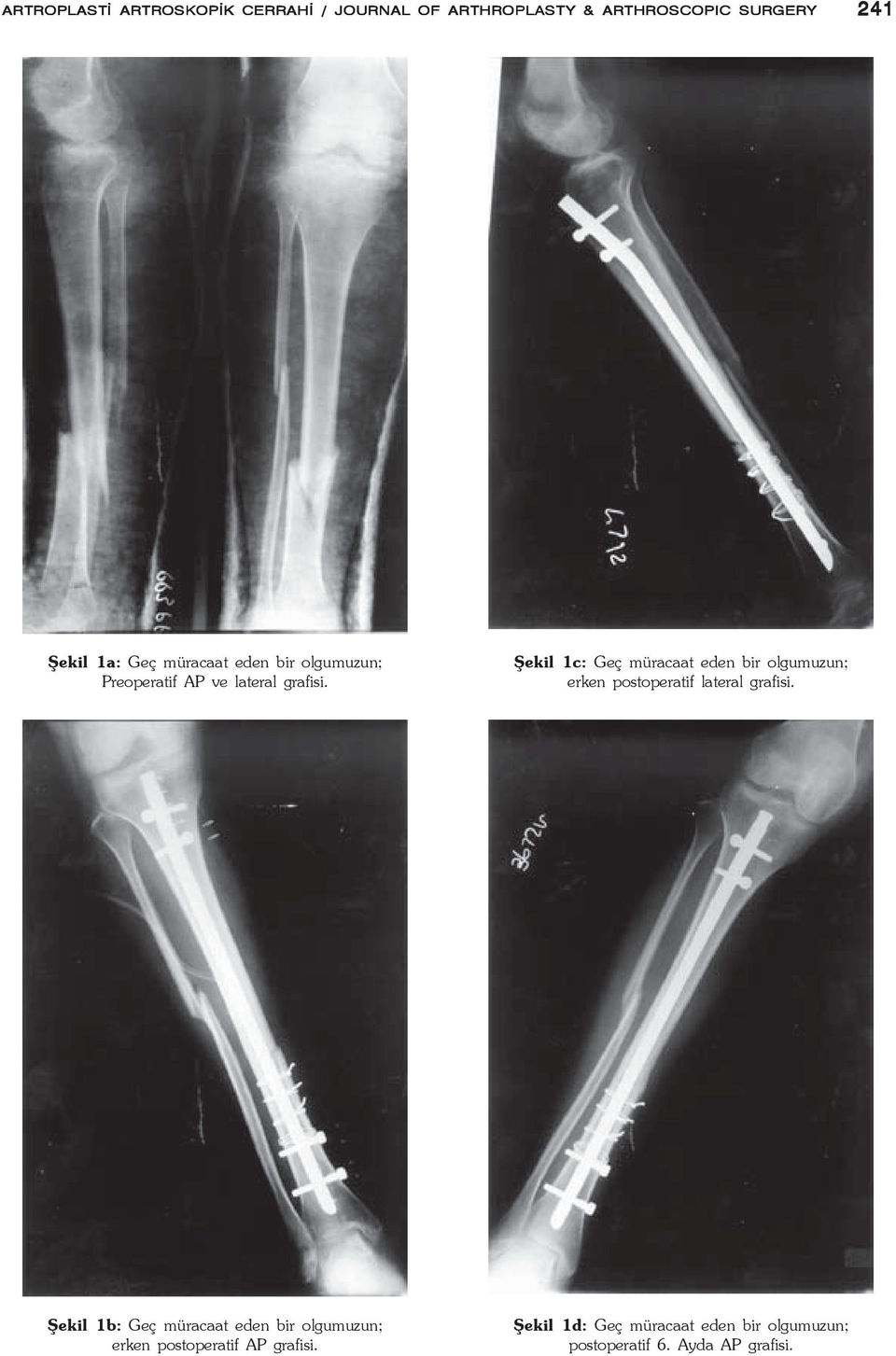 Þekil 1c: Geç müracaat eden bir olgumuzun; erken postoperatif lateral grafisi.