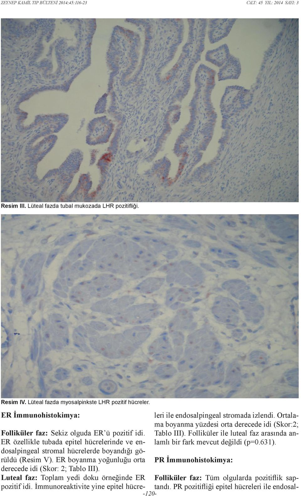 ER özellikle tubada epitel hücrelerinde ve endosalpingeal stromal hücrelerde boyandığı görüldü (Resim V). ER boyanma yoğunluğu orta derecede idi (Skor: 2; Tablo III).