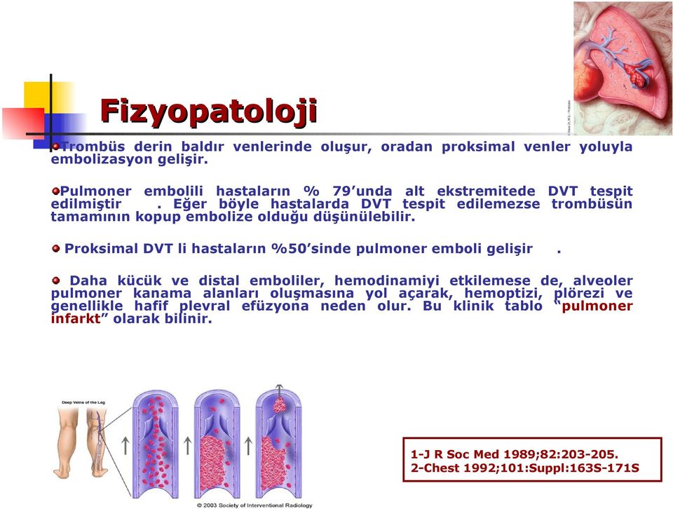 Eğer böyle hastalarda DVT tespit edilemezse trombüsün tamamının kopup embolize olduğu düşünülebilir.