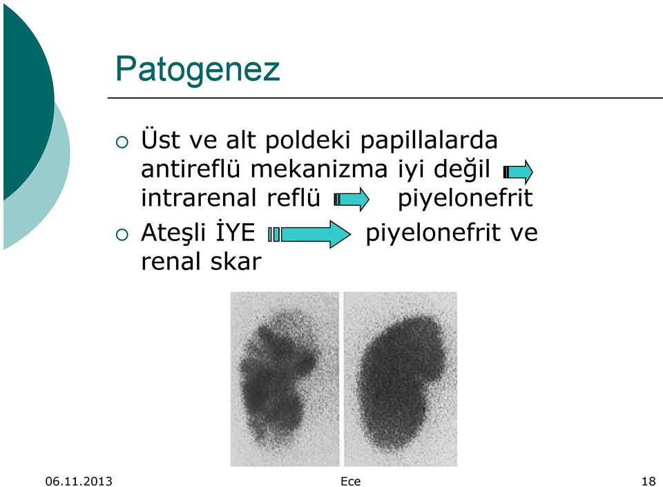 değil intrarenal reflü piyelonefrit