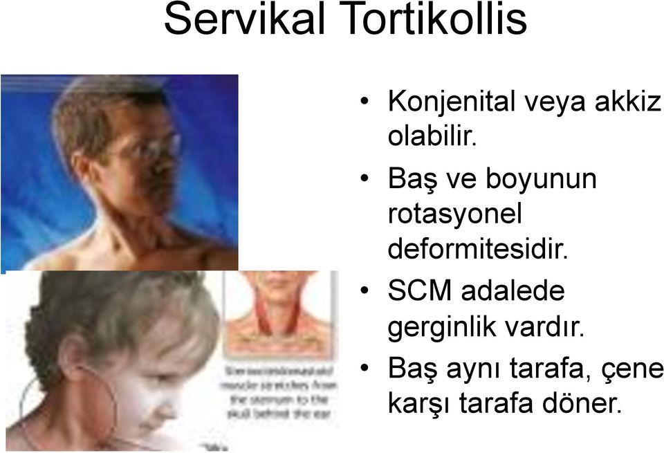 Baş ve boyunun rotasyonel deformitesidir.