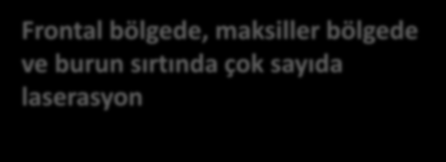 25 yaşında erkek Olgu Künt kafa travmasıyla Travma Acil Polikliniği ne getirildi - Motosiklet kazası (kendi kullanırken, kasksız) İlk Muayene: - Bilinç açık, oryantasyon kooperasyon