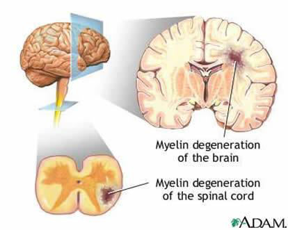 MULTİPLE SKLEROZ Multipl Skleroz (MS) ataklar halinde gelen, ilerleyici olabilen, genetik bir yatkınlığın varlığında, otoimmun nedenle ortaya çıkan temel olarak myelin yıkımı, sekonder aksonal