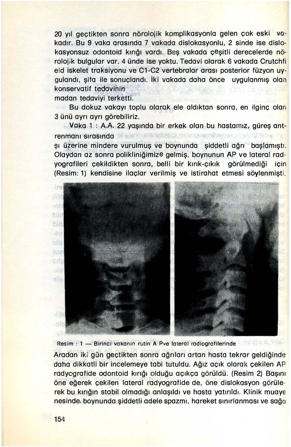 Tedavi olarak 6 vakada Crutchfi eld iskelet traksiyonu ve C1-C2 vertebralar arası posterior füzyon uygulandı, şifa ile sonuçlandı. jki vakada daha önce konservatif t a.
