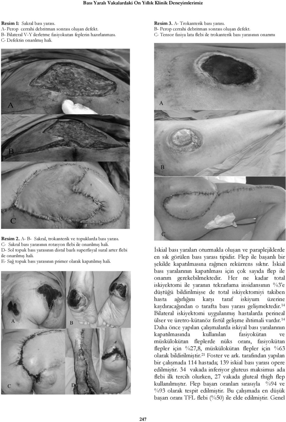 A- B- Sakral, trokanterik ve topuklarda bası yarası. C- Sakral bası yarasının rotasyon flebi ile onarılmış hali.