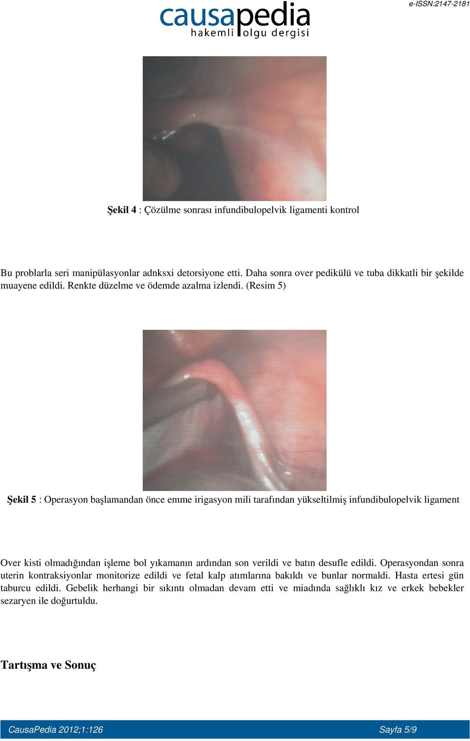 (Resim 5) Şekil 5 : Operasyon başlamandan önce emme irigasyon mili tarafından yükseltilmiş infundibulopelvik ligament Over kisti olmadığından işleme bol yıkamanın ardından son