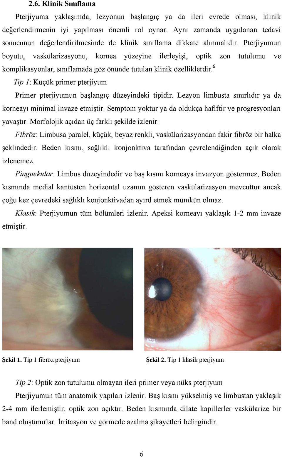 Pterjiyumun boyutu, vaskülarizasyonu, kornea yüzeyine ilerleyişi, optik zon tutulumu ve komplikasyonlar, sınıflamada göz önünde tutulan klinik özelliklerdir.