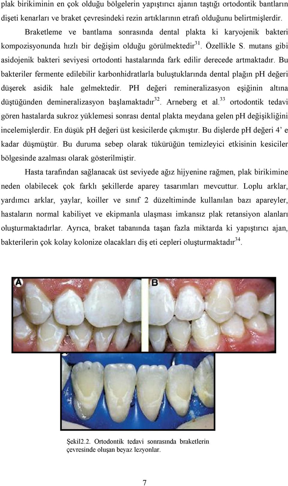 mutans gibi asidojenik bakteri seviyesi ortodonti hastalarında fark edilir derecede artmaktadır.