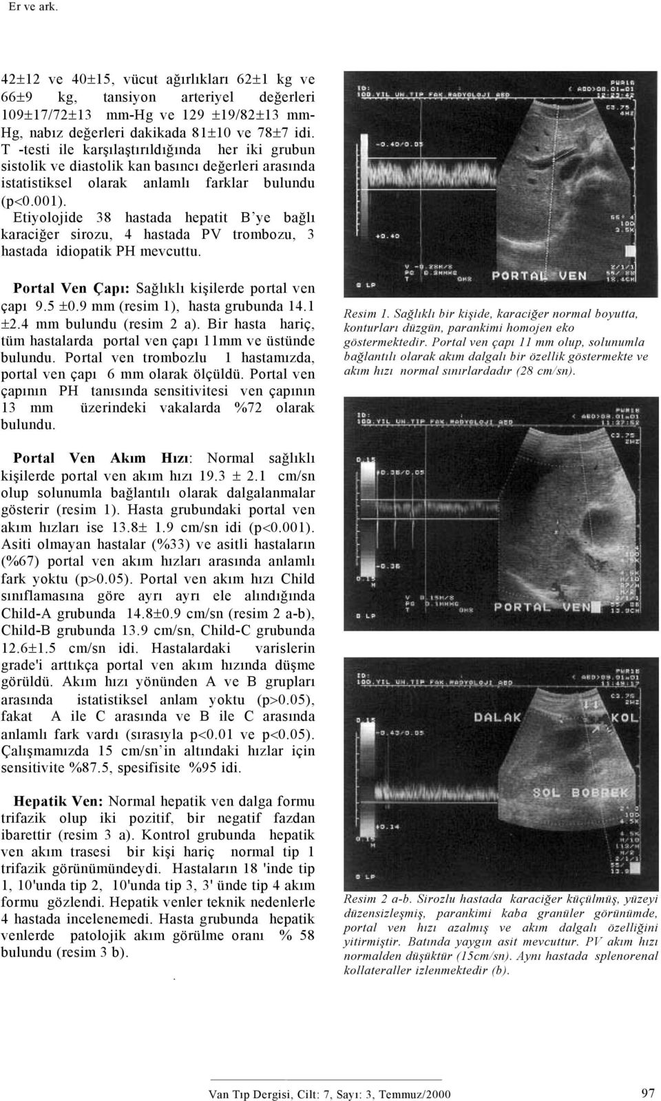 Etiyolojide 38 hastada hepatit B ye bağlı karaciğer sirozu, 4 hastada PV trombozu, 3 hastada idiopatik PH mevcuttu. Portal Ven Çapı: Sağlıklı kişilerde portal ven çapı 9.5 ±0.