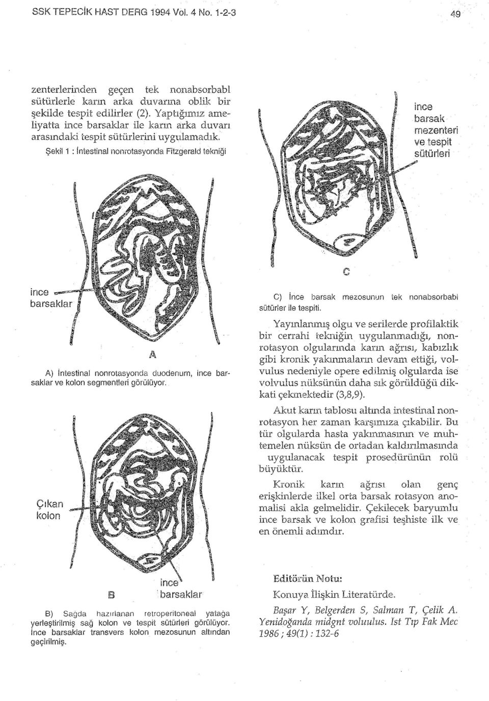 intestinal nonrotasyonda duodenum, ince barsaklar ve kolon segmentleri görülüyor. Çıkan kolon C) ince barsak mezosunun tek nonabsorbabi sütürler ile tespiti.