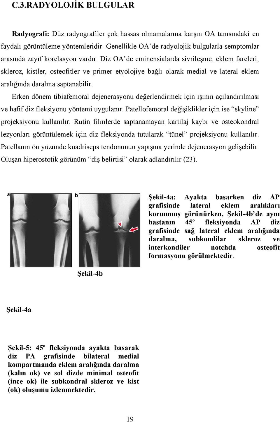 Diz OA de eminensialarda sivrileşme, eklem fareleri, skleroz, kistler, osteofitler ve primer etyolojiye bağlı olarak medial ve lateral eklem aralığında daralma saptanabilir.