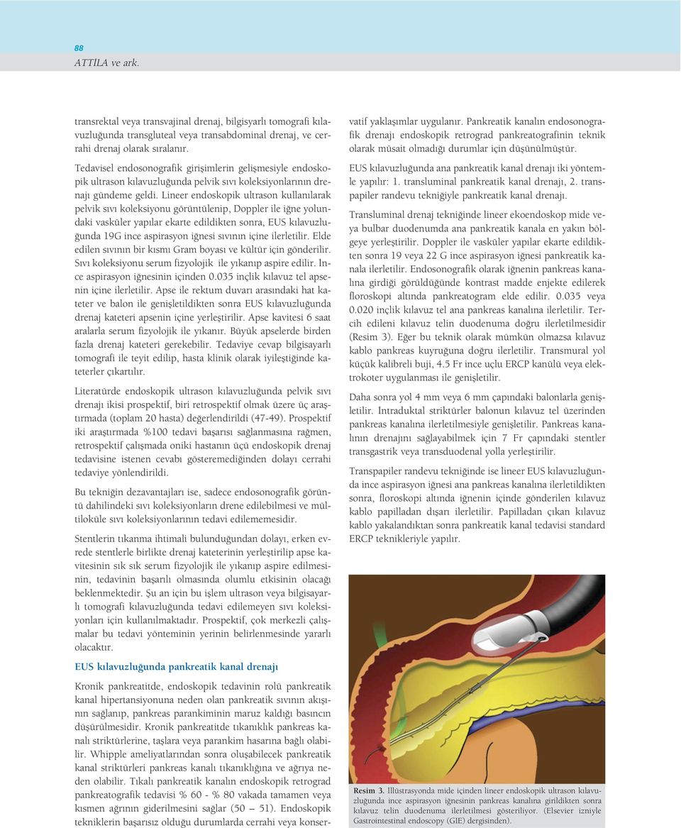 Lineer endoskopik ultrason kullan larak pelvik s v koleksiyonu görüntülenip, Doppler ile i ne yolundaki vasküler yap lar ekarte edildikten sonra, EUS k lavuzlu- unda 19G ince aspirasyon i nesi s v n