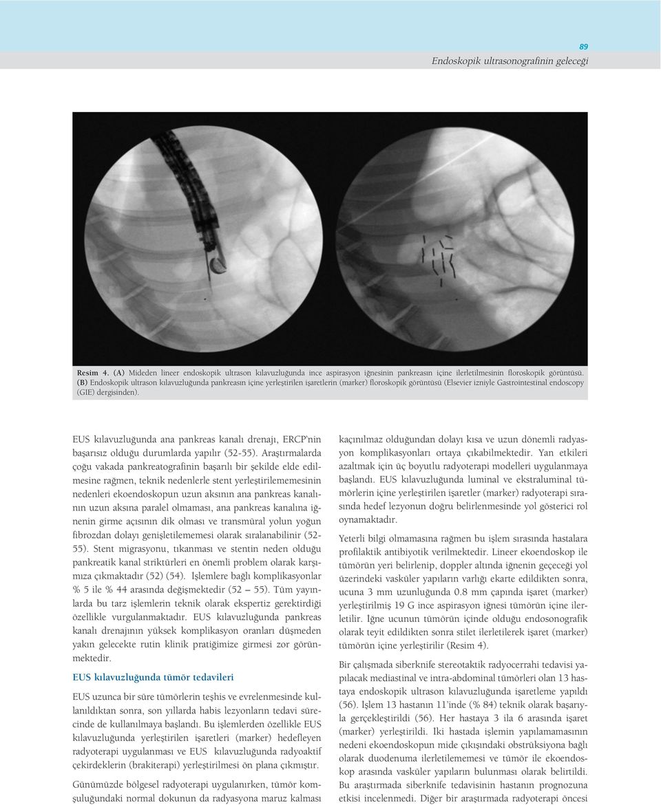EUS k lavuzlu unda ana pankreas kanal drenaj, ERCP nin baflar s z oldu u durumlarda yap l r (52-55).