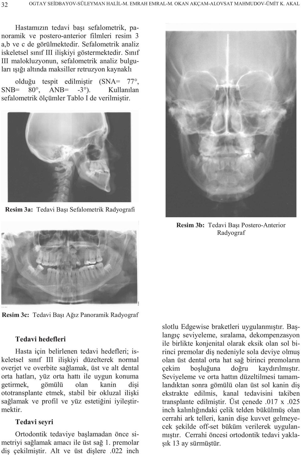 Sınıf III malokluzyonun, sefalometrik analiz bulguları ışığı altında maksiller retruzyon kaynaklı olduğu tespit edilmiştir (SNA= 77, SNB= 80, ANB= -3 ).