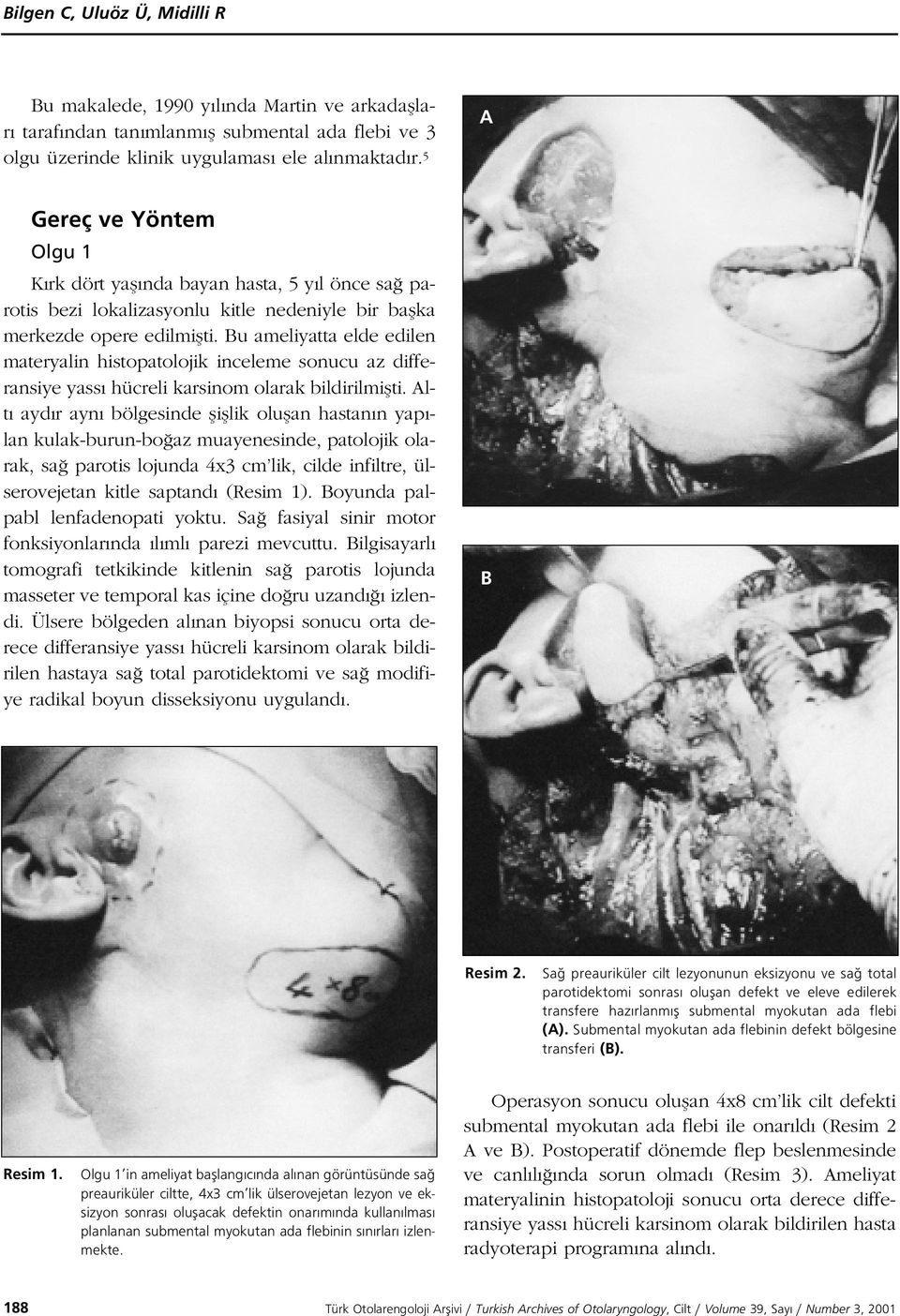 Bu ameliyatta elde edilen materyalin histopatolojik inceleme sonucu az differansiye yass hücreli karsinom olarak bildirilmiflti.