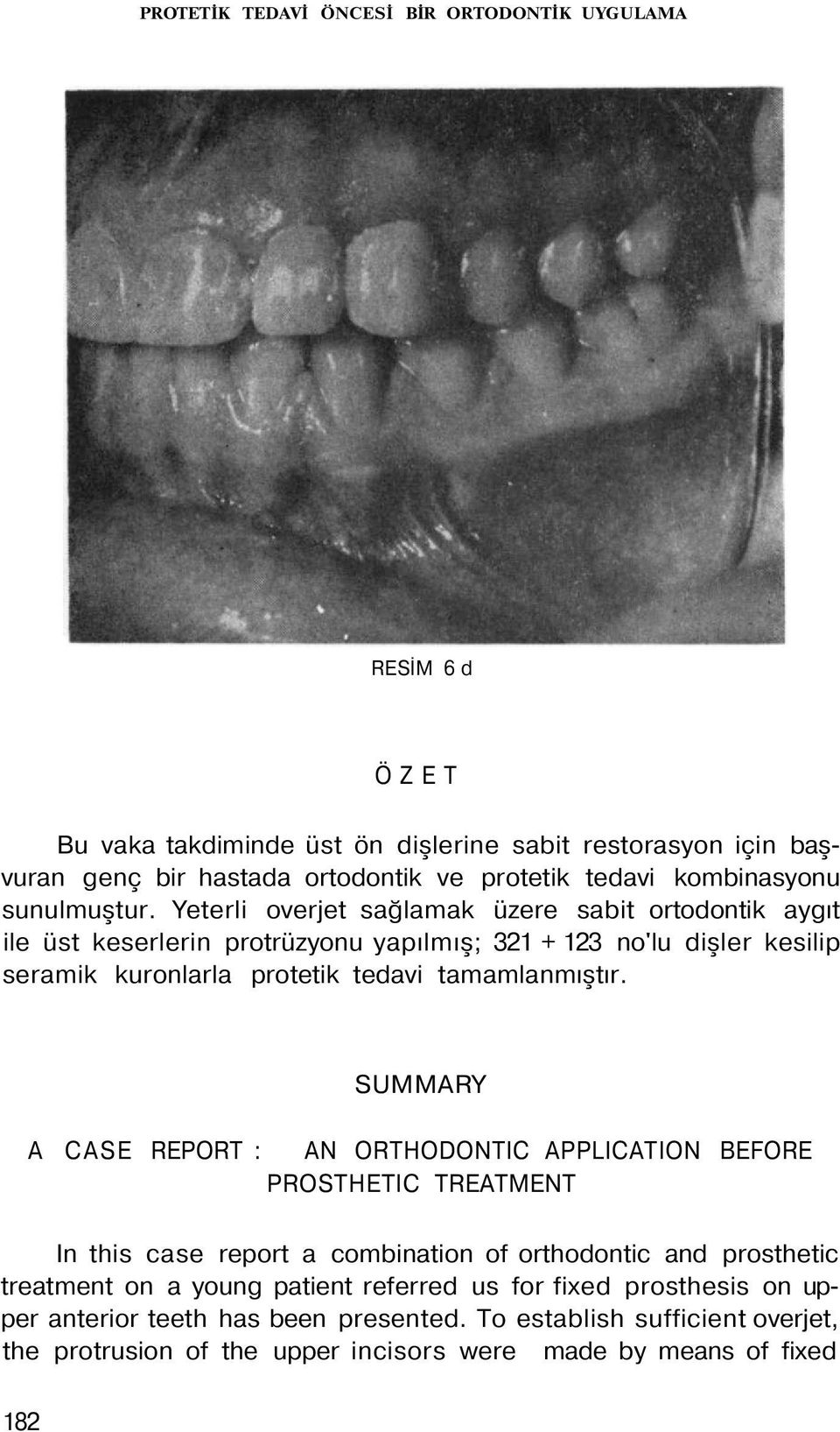 Yeterli overjet sağlamak üzere sabit ortodontik aygıt ile üst keserlerin protrüzyonu yapılmış; 321 + 123 no'lu dişler kesilip seramik kuronlarla protetik tedavi tamamlanmıştır.
