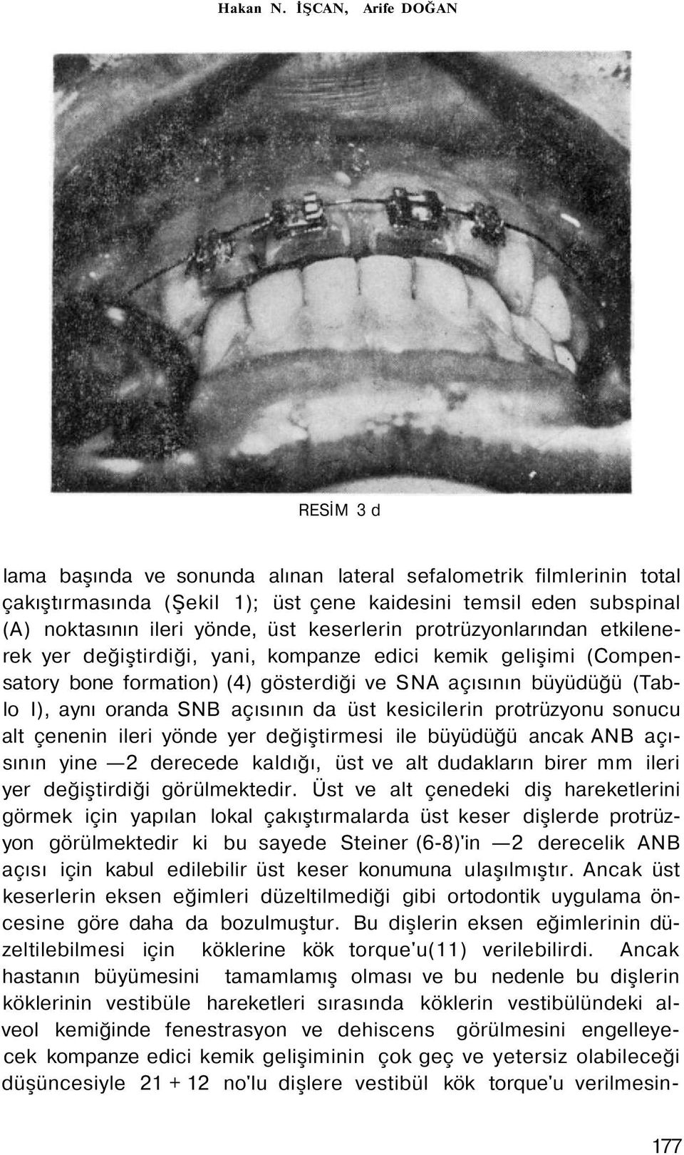 keserlerin protrüzyonlarından etkilenerek yer değiştirdiği, yani, kompanze edici kemik gelişimi (Compensatory bone formation) (4) gösterdiği ve SNA açısının büyüdüğü (Tablo I), aynı oranda SNB