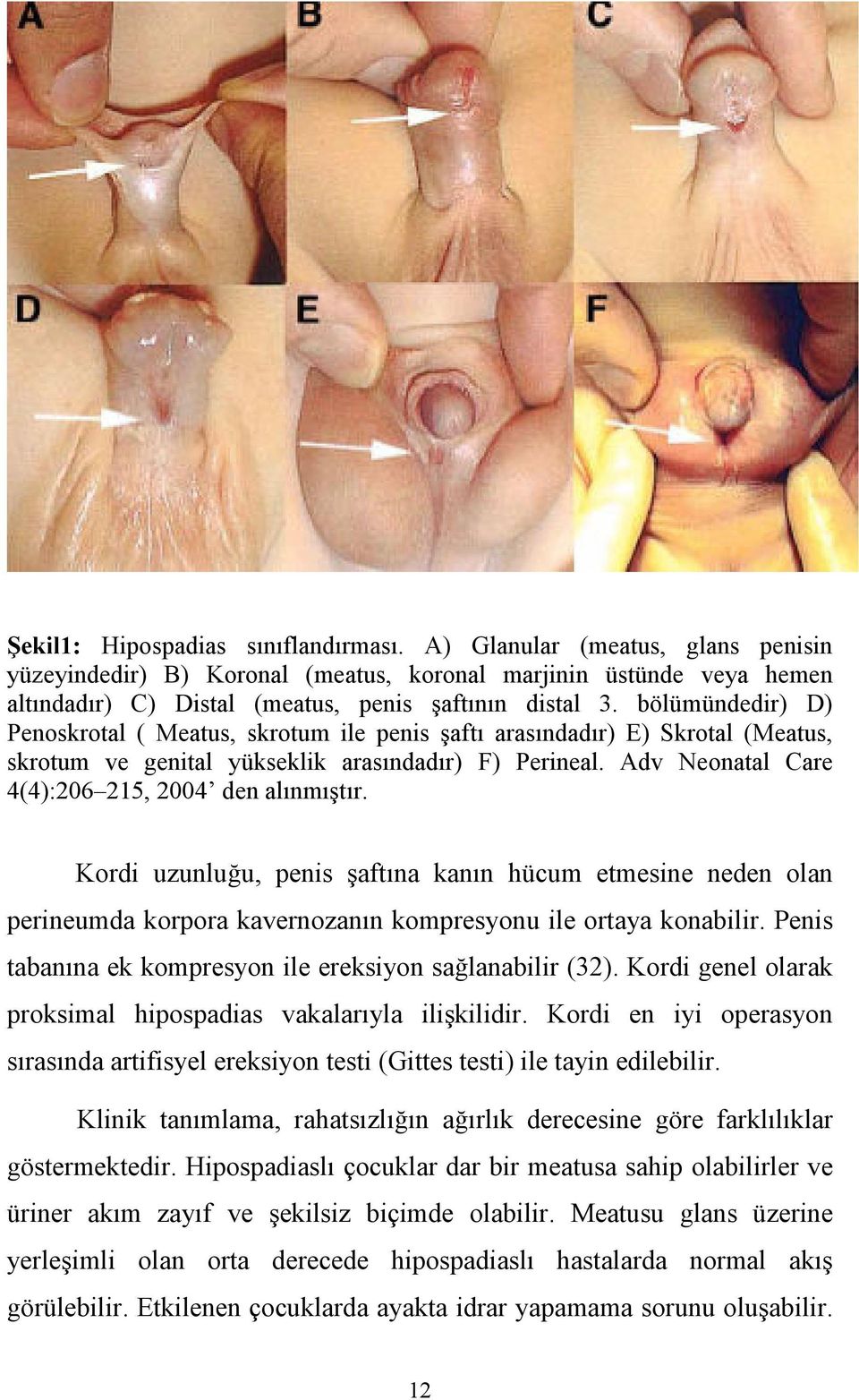 Adv Neonatal Care 4(4):206 215, 2004 den alınmıştır. Kordi uzunluğu, penis şaftına kanın hücum etmesine neden olan perineumda korpora kavernozanın kompresyonu ile ortaya konabilir.