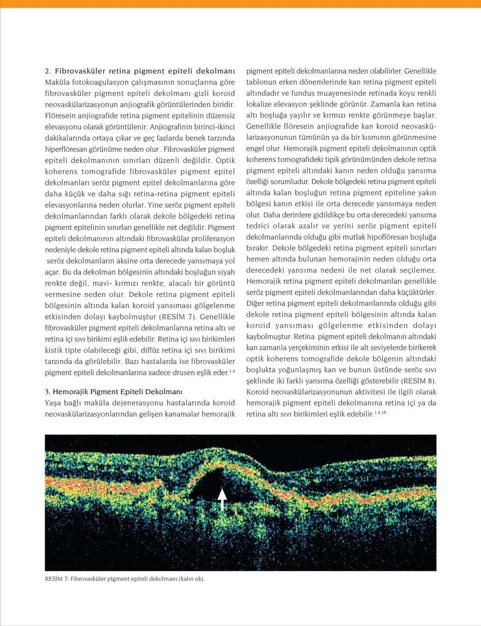 Anjiografinin birinci-ikinci dakikalar nda ortaya ç kar ve geç fazlarda benek tarz nda hiperflöresan görünüme neden olur. Fibrovasküler pigment epiteli dekolman n n s n rlar düzenli de ildir.