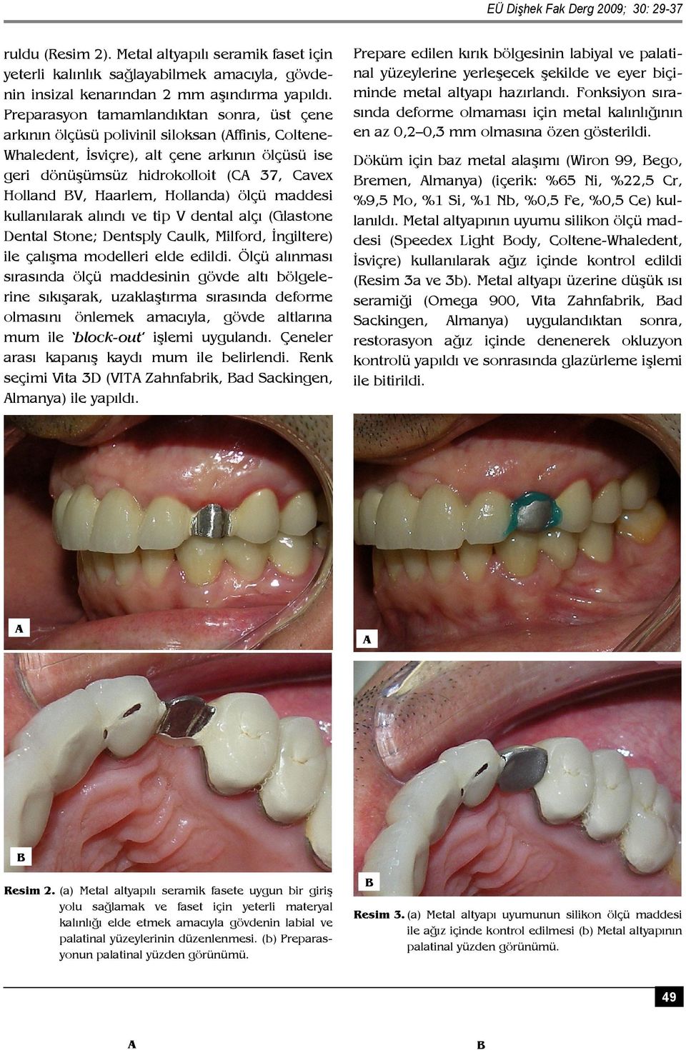 Haarlem, Hollanda) ölçü maddesi kullanılarak alındı ve tip V dental alçı (Glastone Dental Stone; Dentsply Caulk, Milford, İngiltere) ile çalışma modelleri elde edildi.