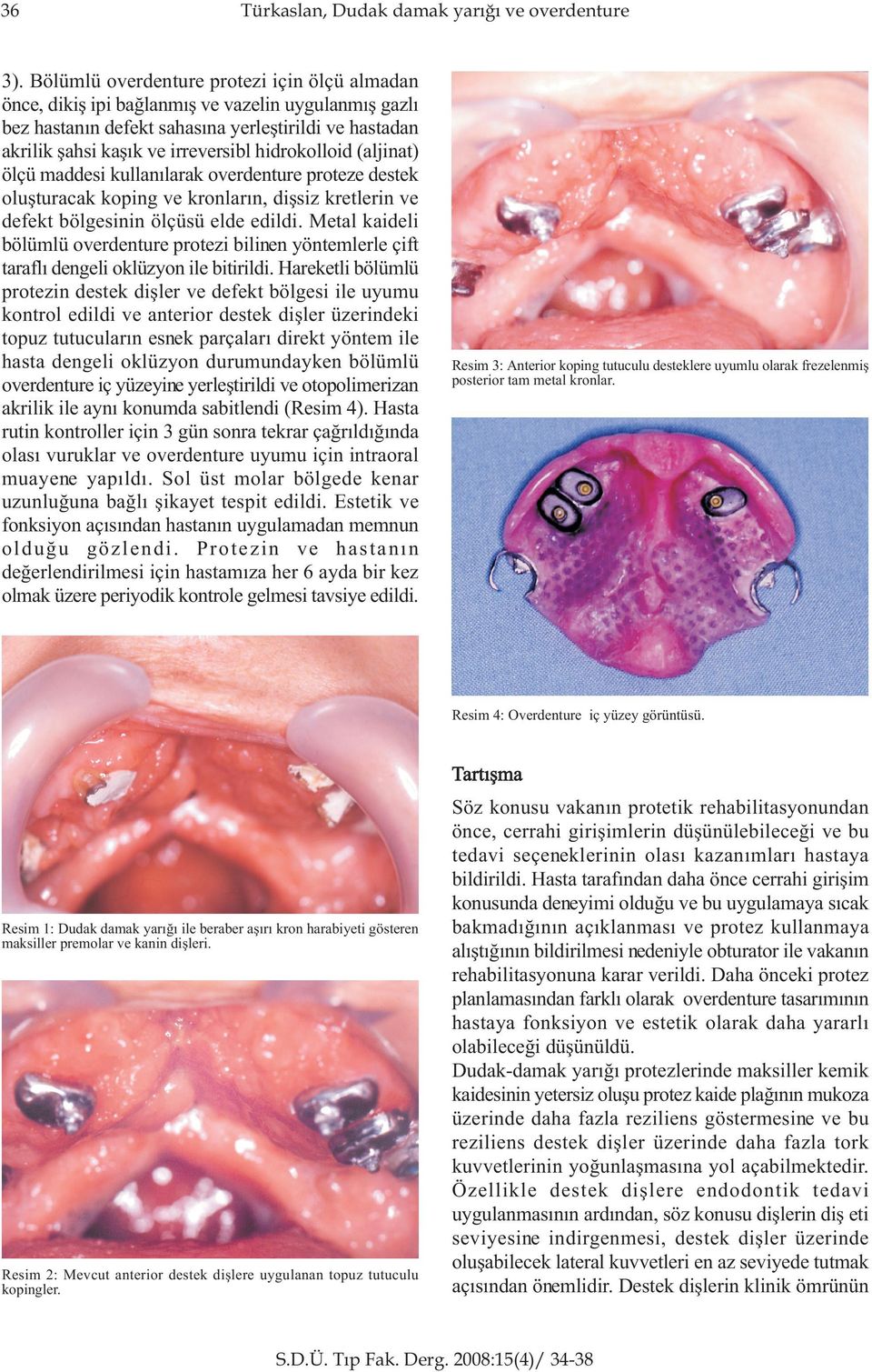 hidrokolloid (aljinat) ölçü maddesi kullanýlarak overdenture proteze destek oluþturacak koping ve kronlarýn, diþsiz kretlerin ve defekt bölgesinin ölçüsü elde edildi.