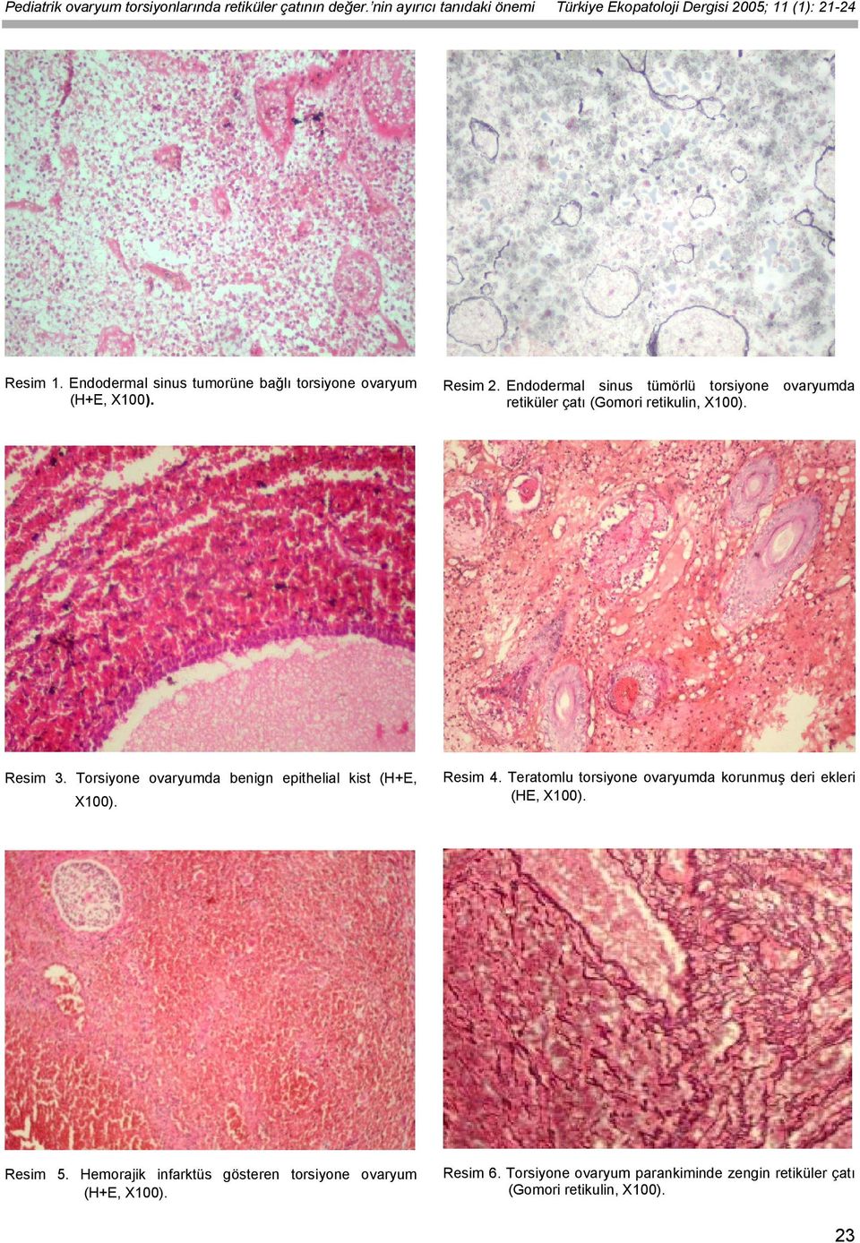 Endodermal sinus tümörlü torsiyone ovaryumda retiküler çatı (Gomori retikulin, X100). Resim 3. Torsiyone ovaryumda benign epithelial kist (H+E, X100).