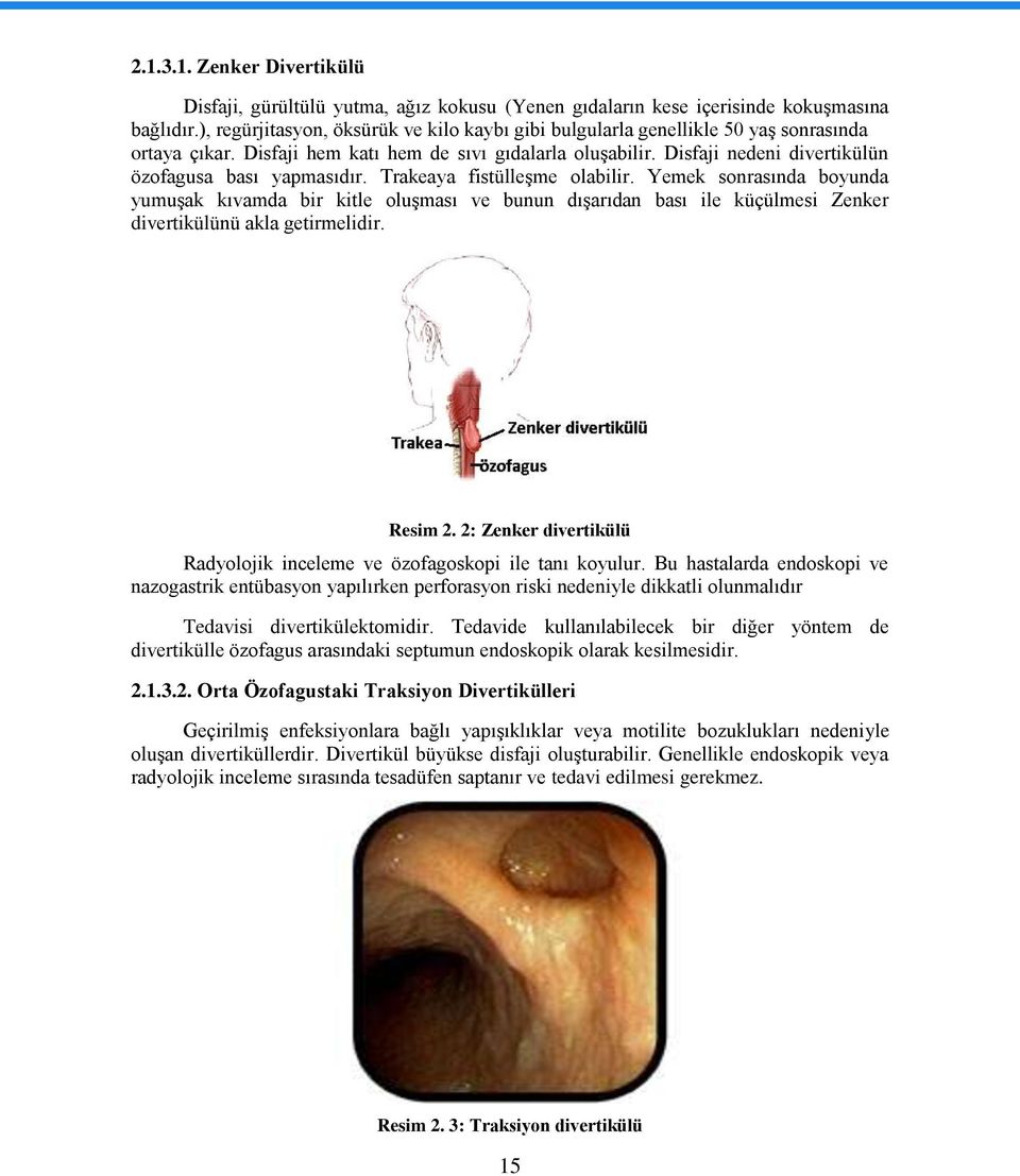 Disfaji nedeni divertikülün özofagusa bası yapmasıdır. Trakeaya fistülleģme olabilir.