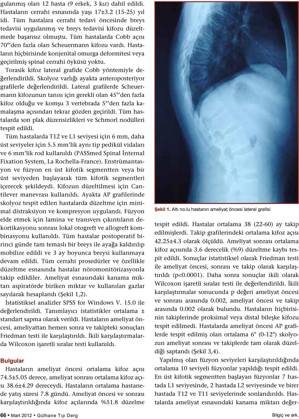 Hastaların hiçbirisinde konjenital omurga deformitesi veya geçirilmiş spinal cerrahi öyküsü yoktu. Torasik kifoz lateral grafide Cobb yöntemiyle değerlendirildi.