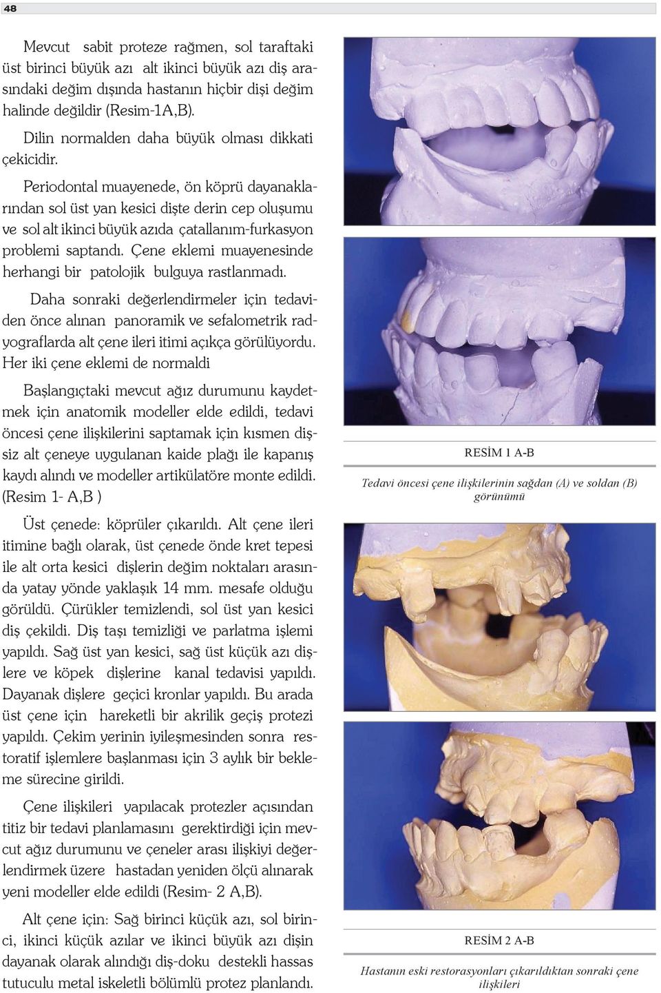 Periodontal muayenede, ön köprü dayanaklarından sol üst yan kesici dişte derin cep oluşumu ve sol alt ikinci büyük azıda çatallanım-furkasyon problemi saptandı.