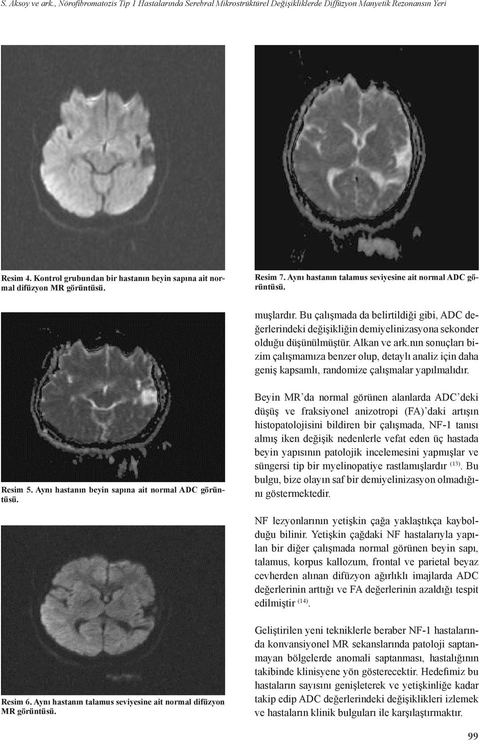 Bu çalışmada da belirtildiği gibi, ADC değerlerindeki değişikliğin demiyelinizasyona sekonder olduğu düşünülmüştür. Alkan ve ark.
