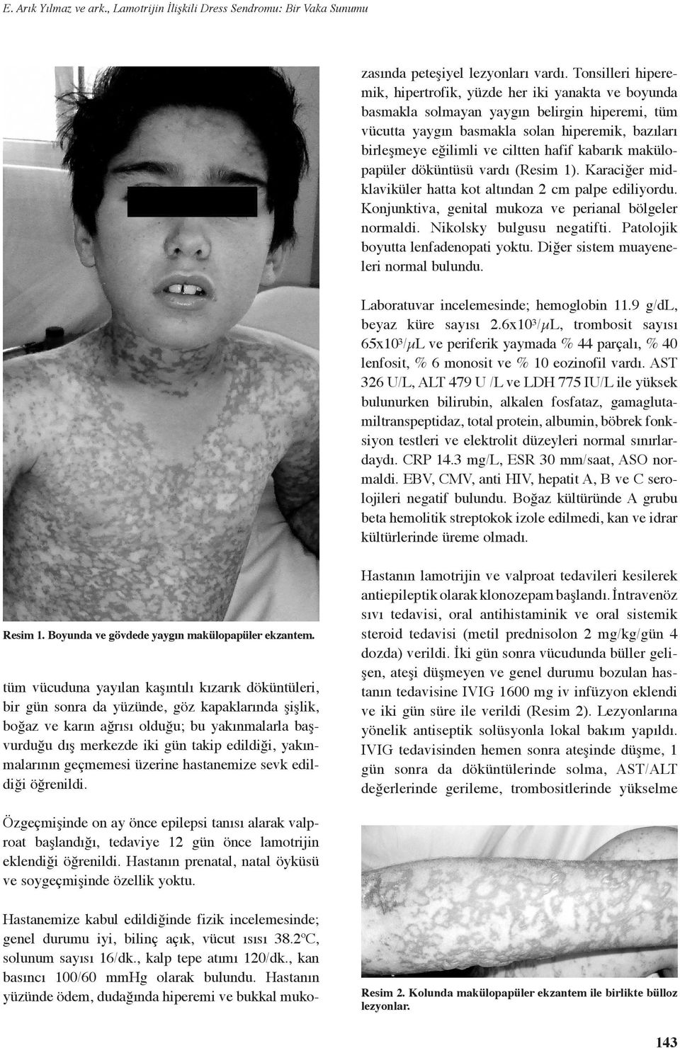 Tonsilleri hiperemik, hipertrofik, yüzde her iki yanakta ve boyunda basmakla solmayan yaygın belirgin hiperemi, tüm vücutta yaygın basmakla solan hiperemik, bazıları birleşmeye eğilimli ve ciltten