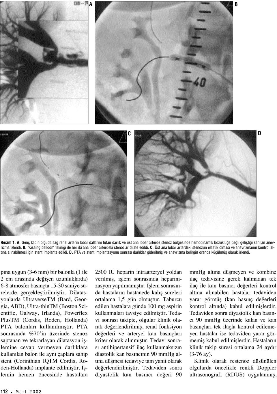 Üst ana lobar arterdeki stenozun elastik olmas ve anevrizman n kontrol alt na al nabilmesi için stent implante edildi. D.