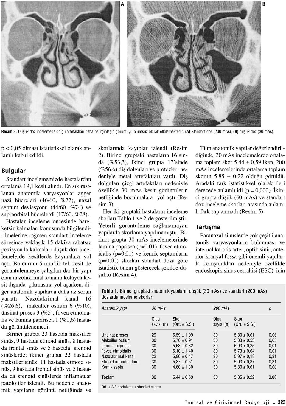 En s k rastlanan anatomik varyasyonlar agger nazi hücreleri (46/60, %77), nazal septum deviasyonu (44/60, %74) ve supraorbital hücrelerdi (17/60, %28).