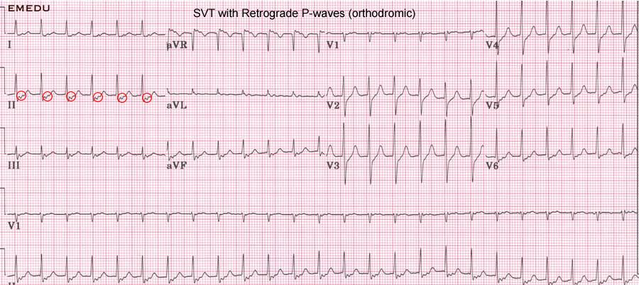 AVRT Atriyo