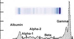 Taşma (Overflow) proteinürisi SORUN Filtre edilen proteinlerin proximal tubül geri emilim kapasitesini