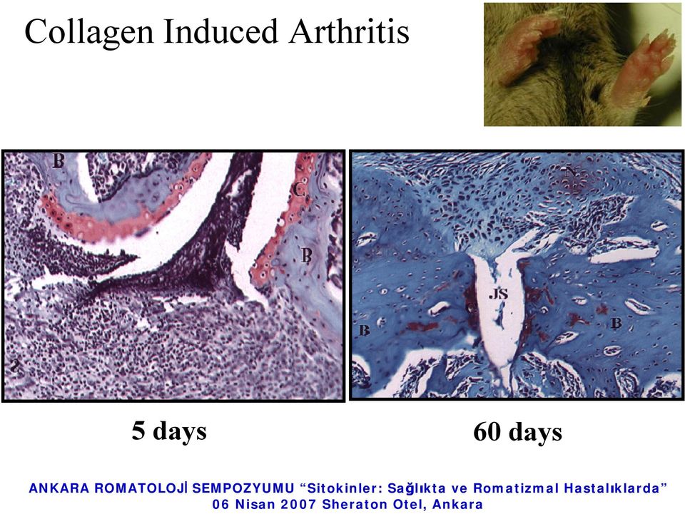 Arthritis